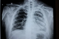 Kaburga Kırığı Belirtileri ve Tedavisi