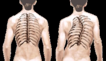 Kaburga Eğriliği Tanı ve Tedavi
